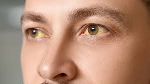 yeux jaunes l'un des symptômes de la cirrhose du foie.