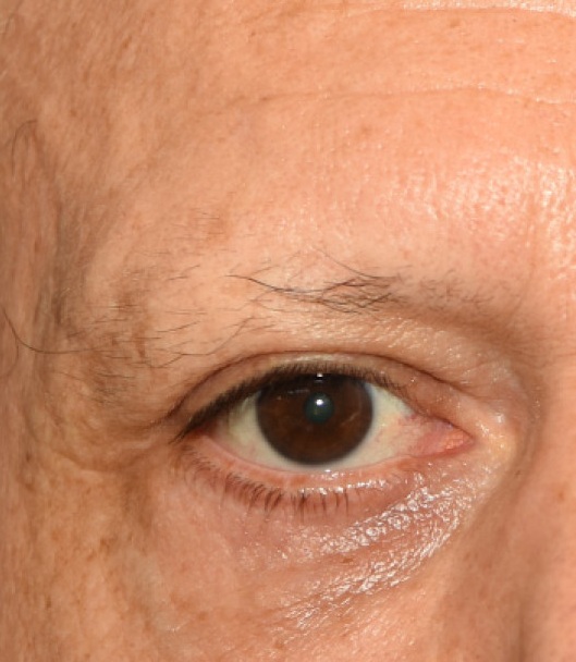 Quand la thyroïde flanche : le signe de la queue des sourcils