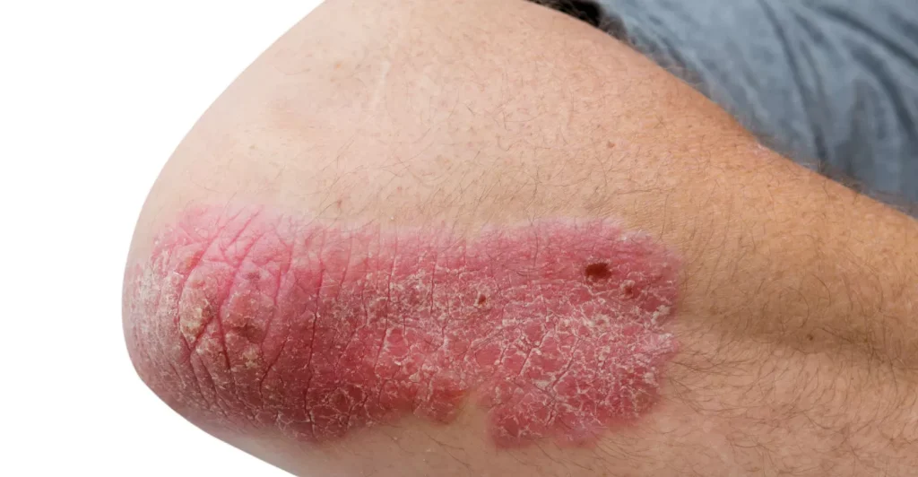 Le psoriasis sur la peau