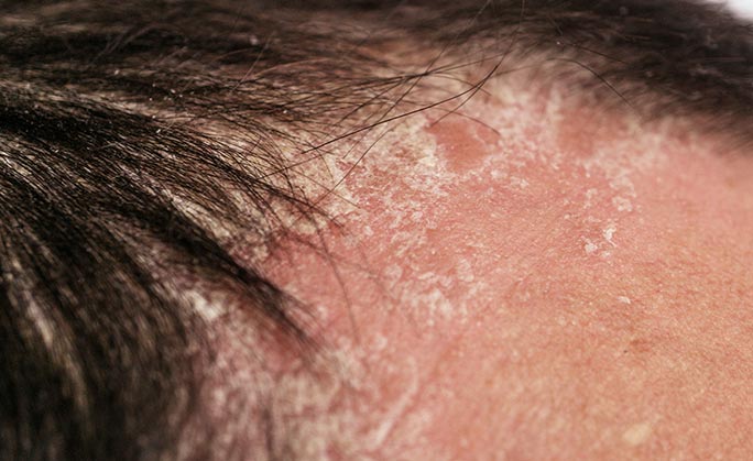 Le psoriasis sur le cuir chevelu