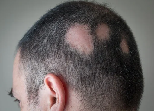 La teigne détruit le cuir chevelu et la peau